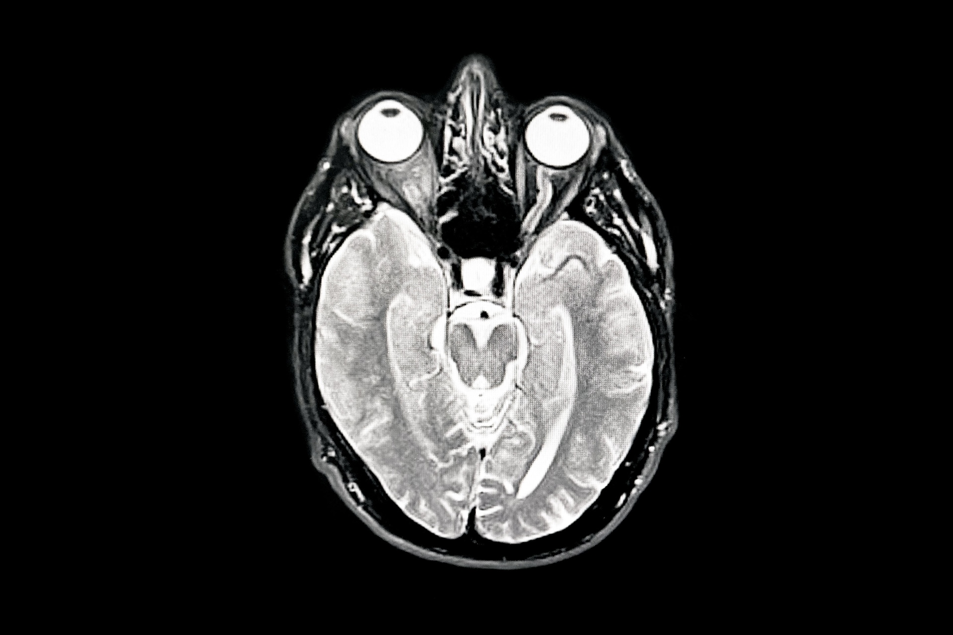 a top-down MRI image showing a slightly shrunken brain