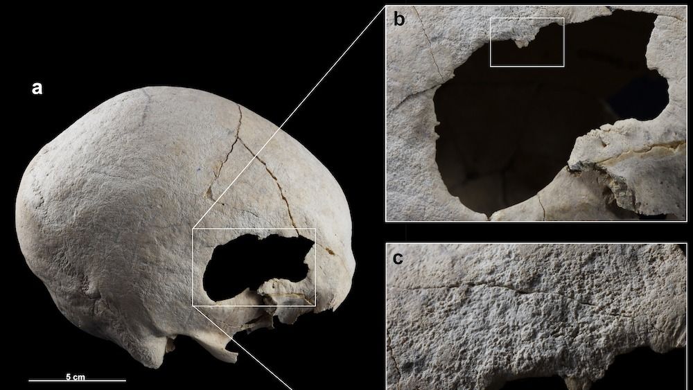 A skull with a hole in it (at right) and magnified images of the hole and scrape marks (at left)