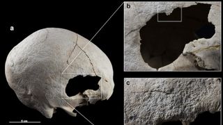 A skull with a hole in it (at right) and magnified images of the hole and scrape marks (at left)