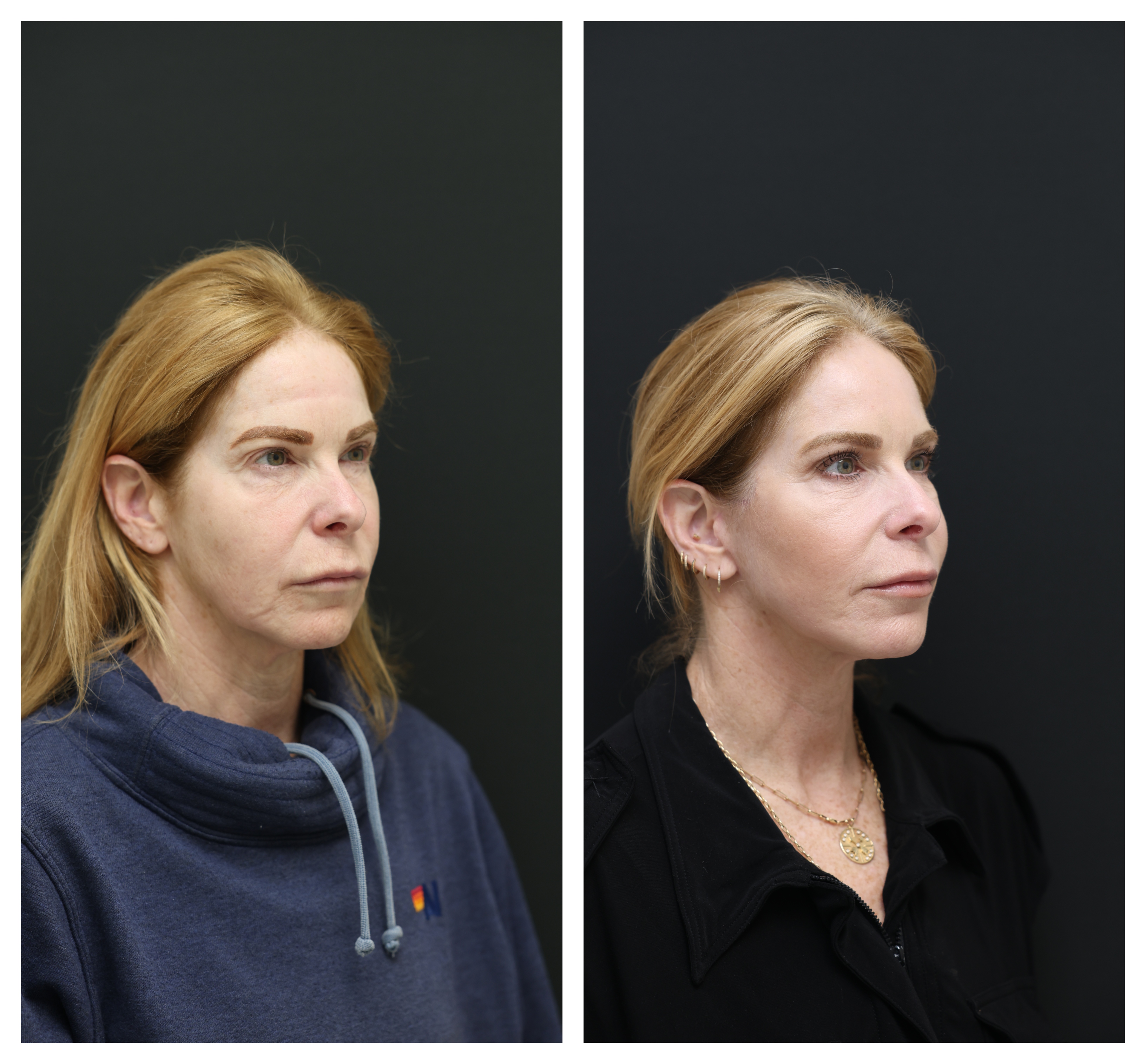 jenn before and after facelift