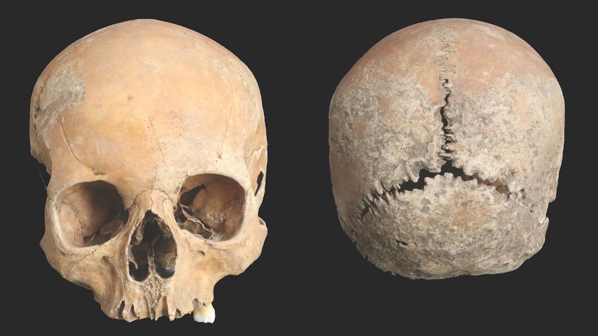 The cleaned cranium of the 15- to 18-year-old teenager, whose face was mutilated in Anglo-Saxon England. 