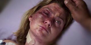Grey's Anatomy Meredith's badly bruised face is shown as she lies in a hospital bed