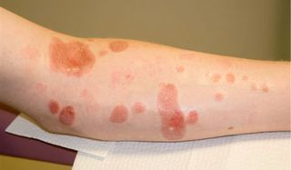 Chemical Burns: Symptoms, Causes, Diagnosis, Treatment