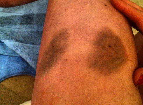 Rosie Fry's bruise