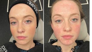 our beauty writer before and during her face gym signature sculpt facial