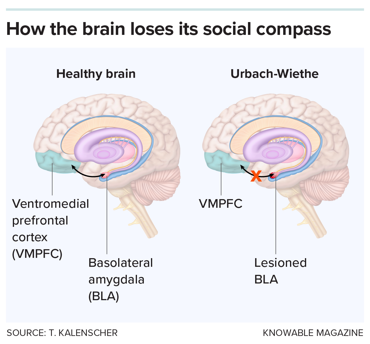 A graphic showing different labeled parts of the brain and how they disconnect with rare genetic disorders