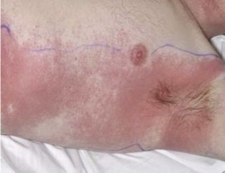 rash between buttocks burns