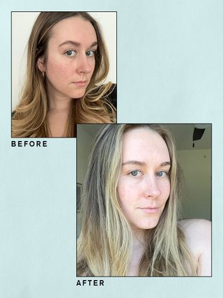 Lyma Laser before and after images from beauty editor Kaitlyn McLintock.