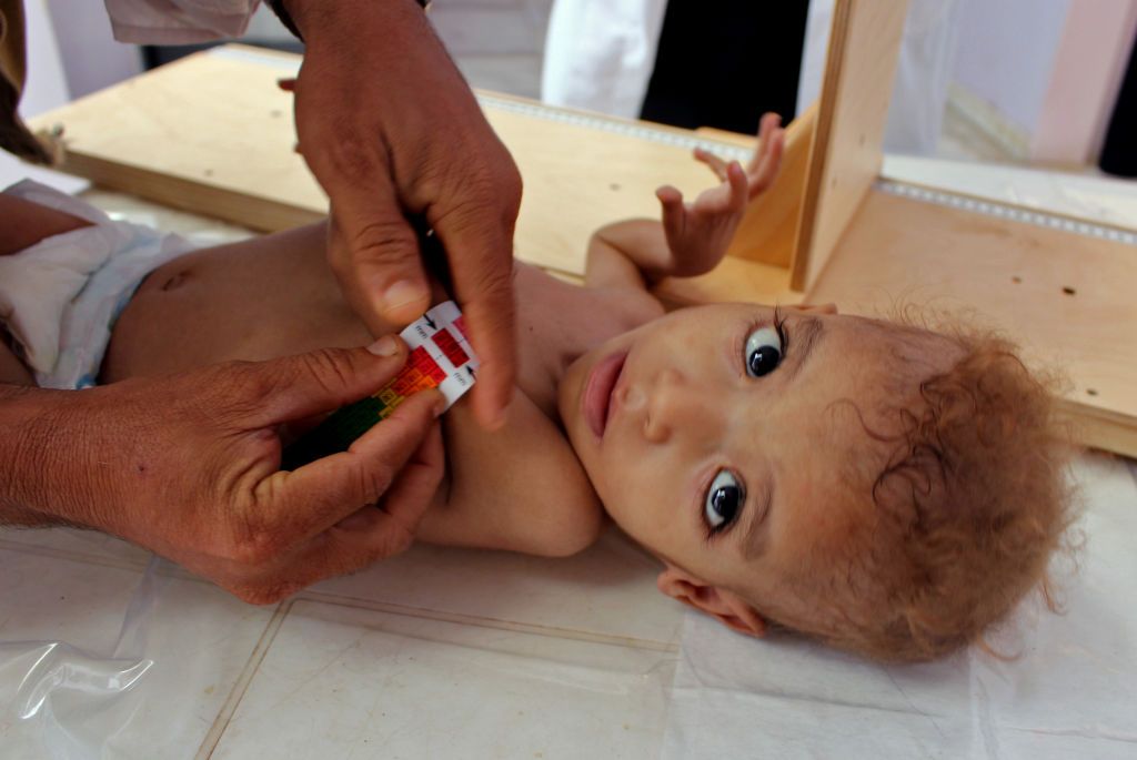 A Yemeni child suffering from severe malnutrition is measured at a treatment centre in a hospital in Yemen&amp;#039;s northwestern Hajjah province, on November 7, 2018. 