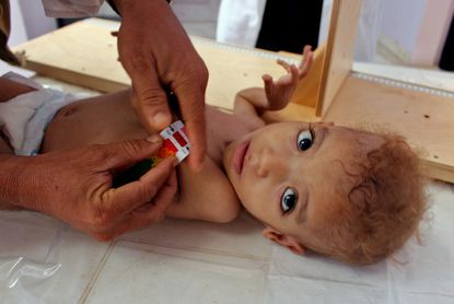 A Yemeni child suffering from severe malnutrition is measured at a treatment centre in a hospital in Yemen's northwestern Hajjah province, on November 7, 2018. 