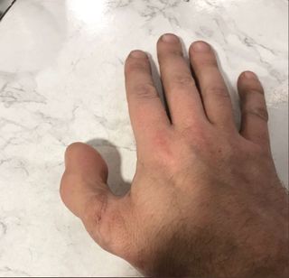 David Lee's hand, post-surgery