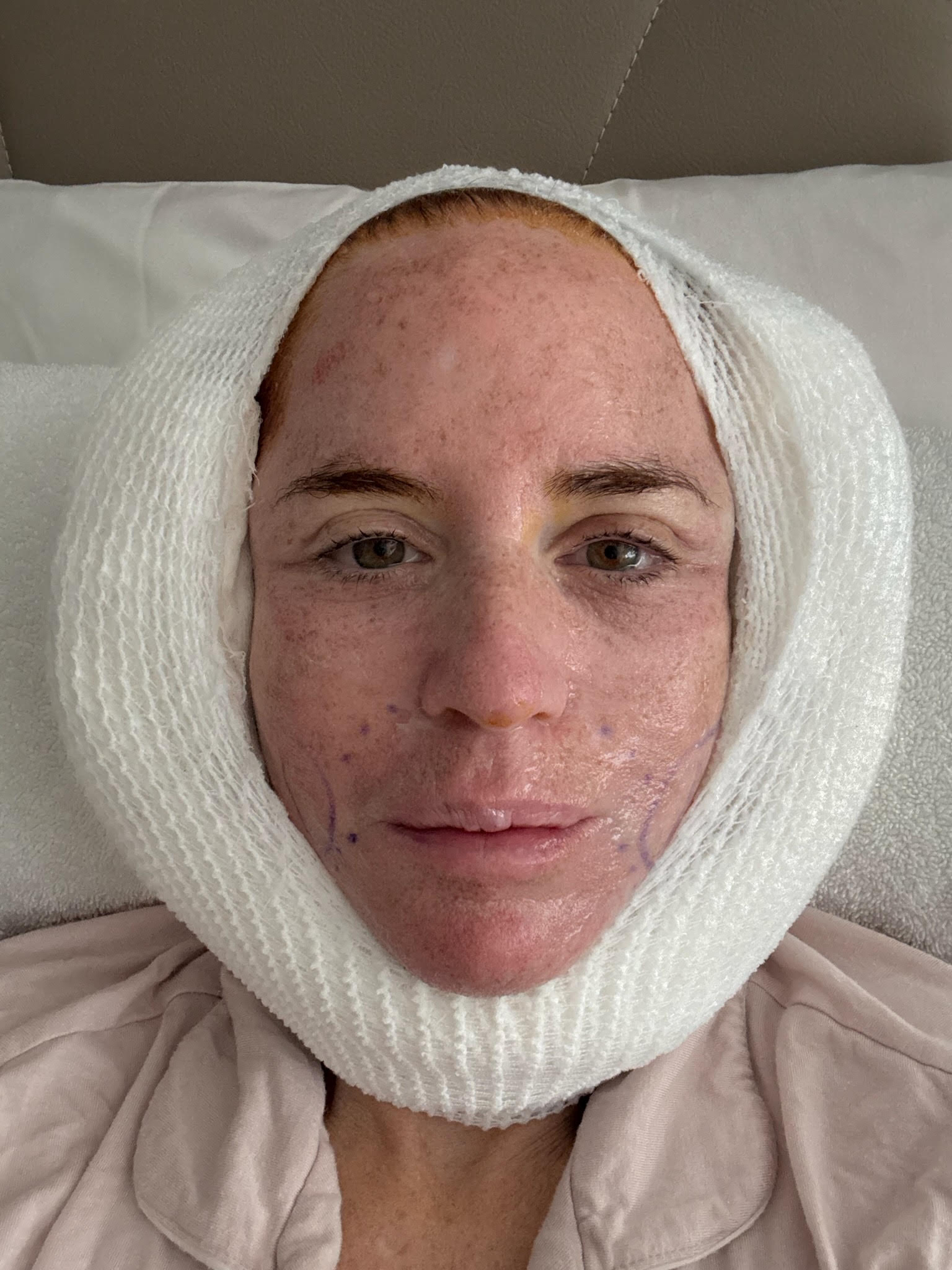 Jenny Hutt immediately after her surgery.