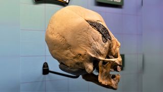 This skull from Peru has a metal implant. If it is authentic then it would be a potentially unique find from the ancient Andes.