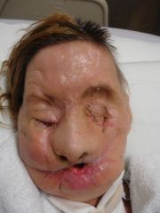 Charla Nash was mauled by a friend's chimpanzee in 2009. This photo was taken before her full face transplant operation.