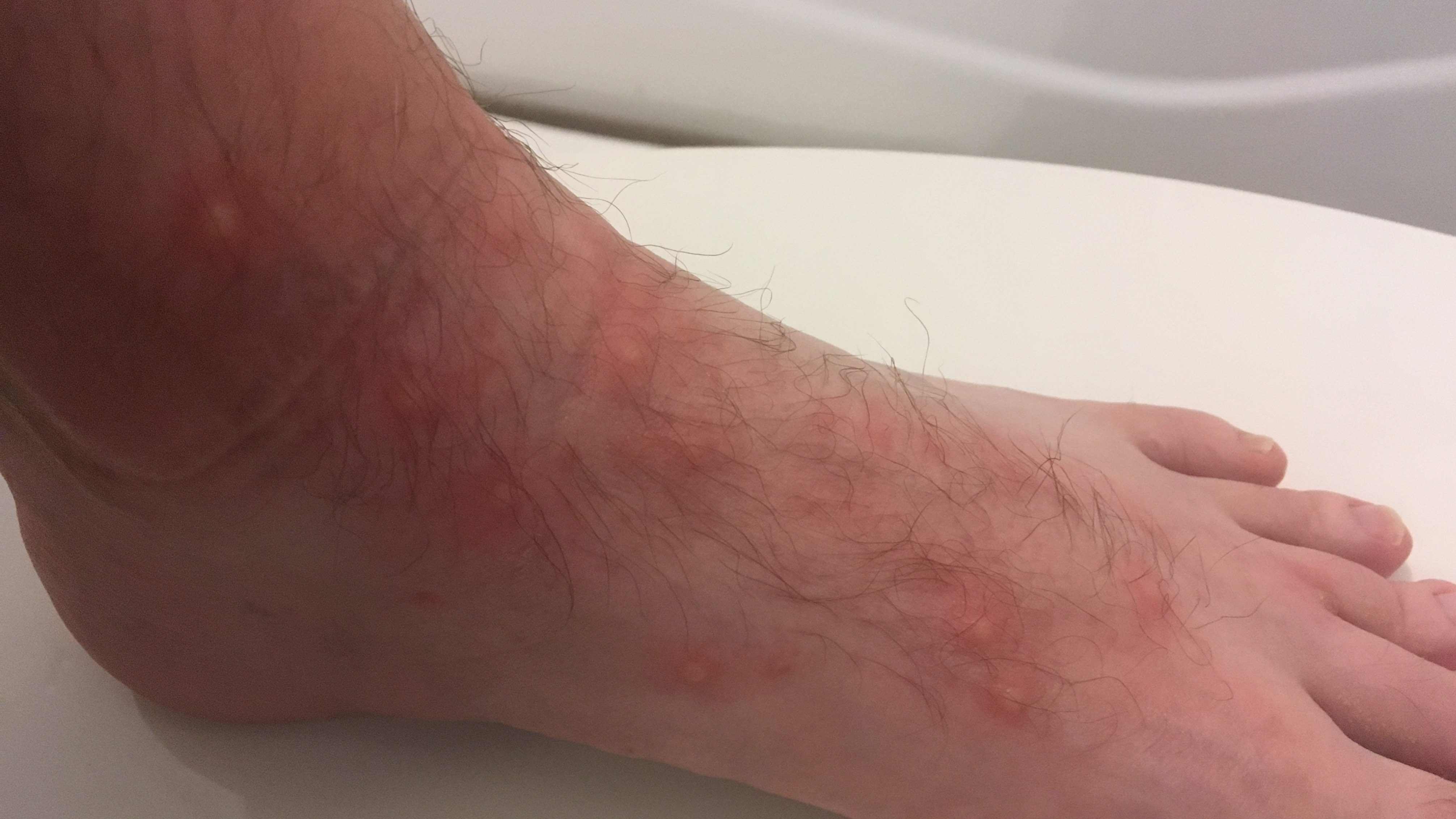 Red chigger bites on foot