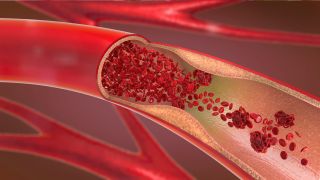 A 3D illustration of a clogged artery