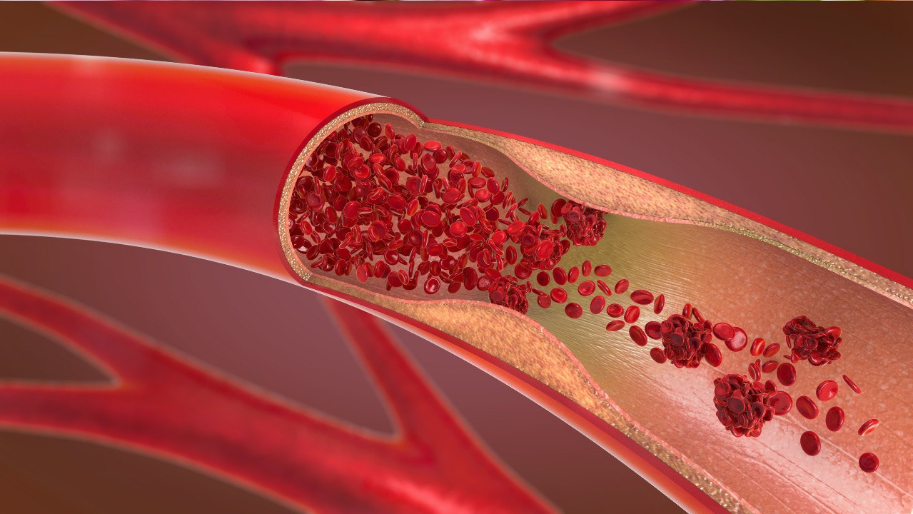 Eine 3D-Darstellung einer verstopften Arterie