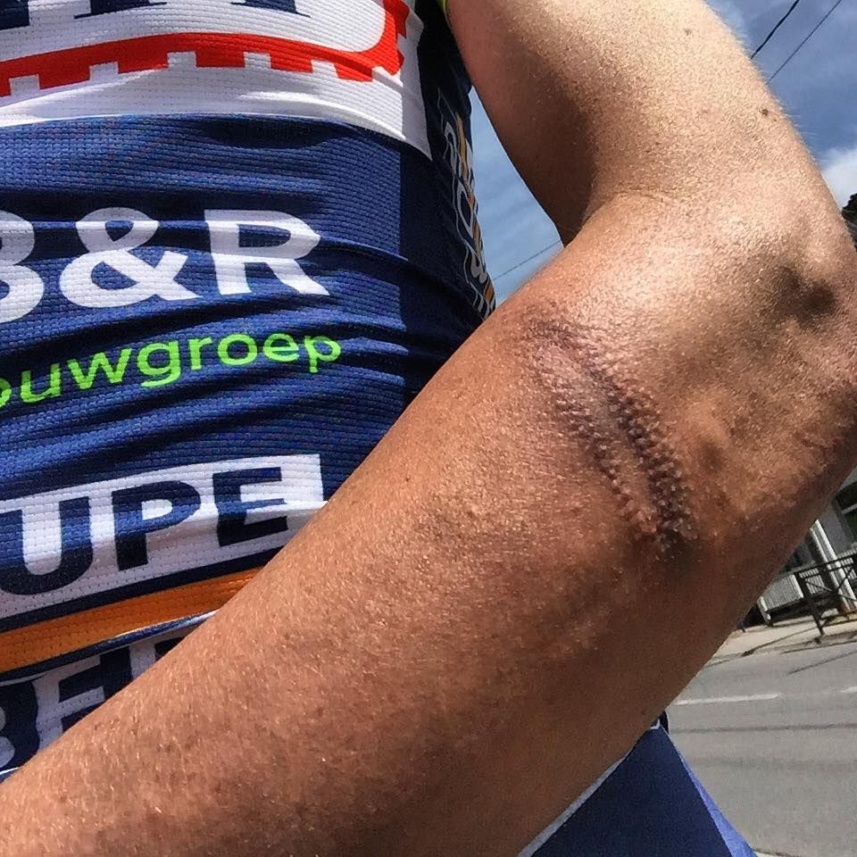 Yoann Offredo after being attacked while training