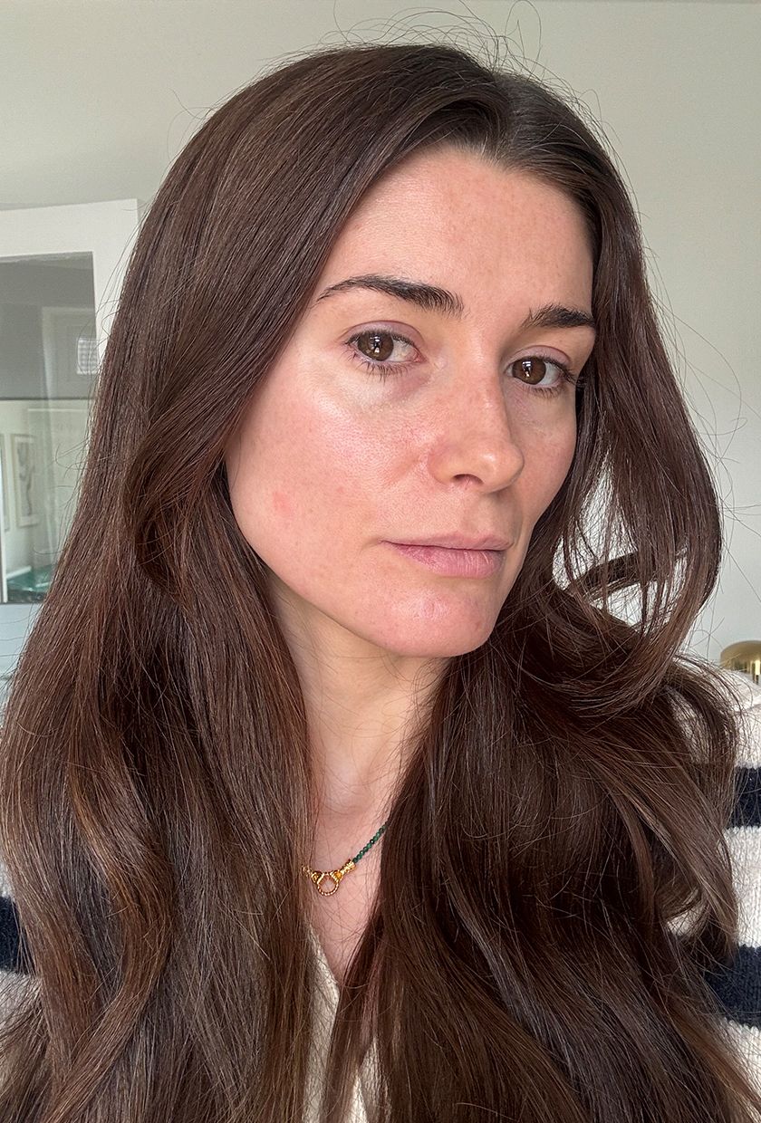 Eleanor before using Shark CryoGlow LED Mask