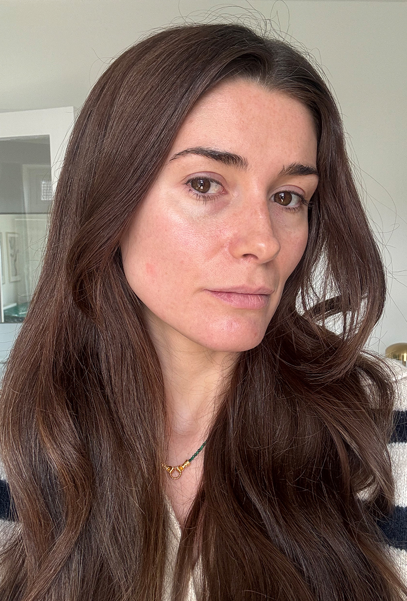 Eleanor before using Shark CryoGlow LED Mask
