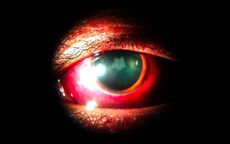 rosette cataract