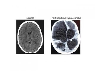 These images are normal (left) and postinfectious (right) hydrocephalus CT scans.