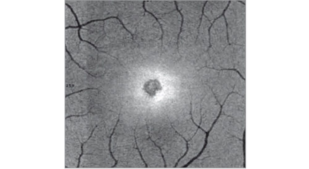 retina, solar retinopathy