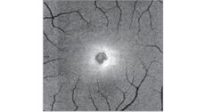 retina, solar retinopathy