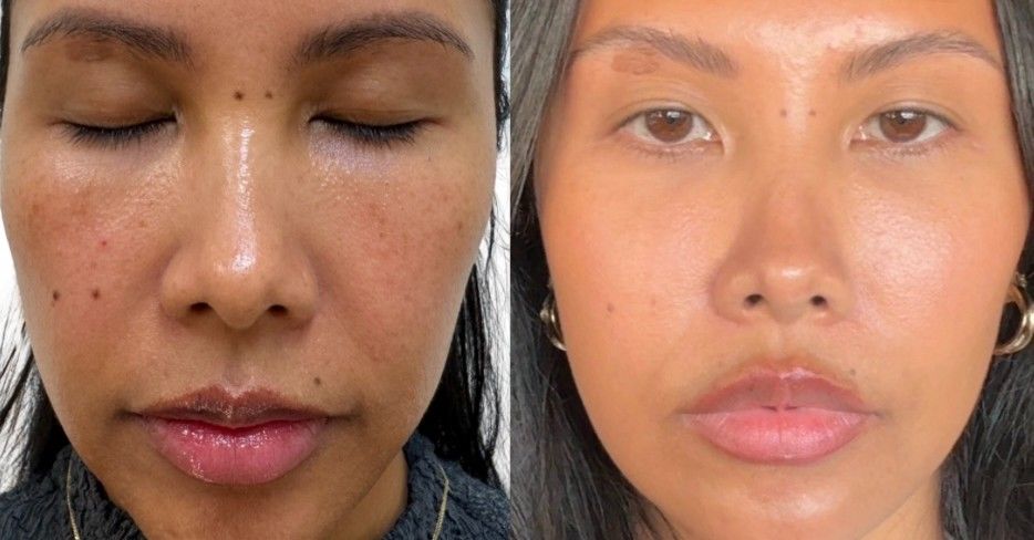 Reviewed: The PicoSure Pro Laser and Its “Glass Skin” Benefits