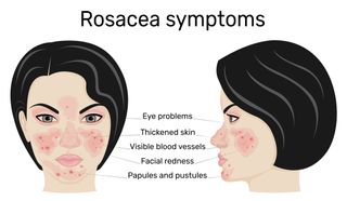 skincare routine for rosacea