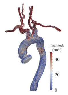 Simulated blood velocity and medication distribution in a patient-specific aorta model.