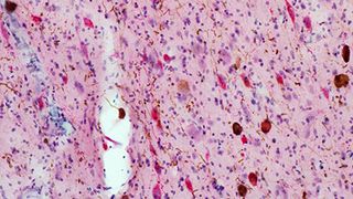 Brain tissue from deceased patients with Alzheimer's has more tau protein buildup (brown spots) and fewer neurons (red spots) as compared to healthy brain tissue.