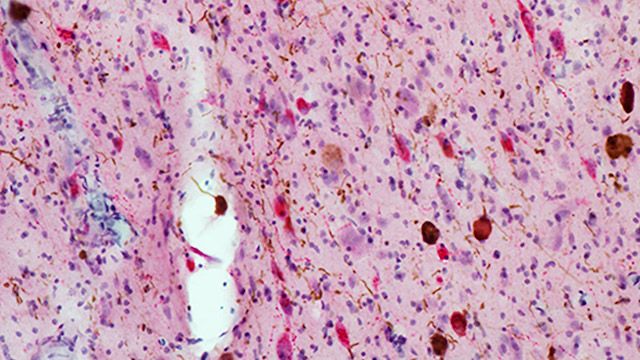 Brain tissue from deceased patients with Alzheimer&#039;s has more tau protein buildup (brown spots) and fewer neurons (red spots) as compared to healthy brain tissue.