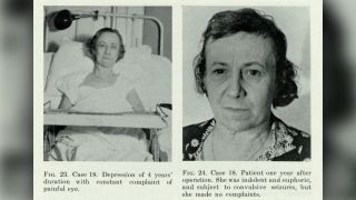 Photos show a female lobotomy patient before the procedure and one year later, in 1942.