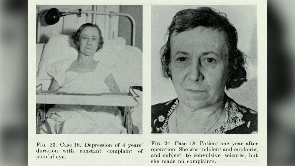 Lobotomy Definition, procedure and history Live Science
