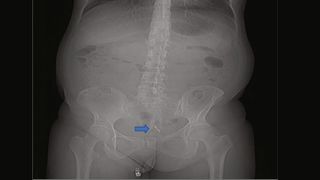 X-ray with arrow pointing to the IUD in the woman's bladder.