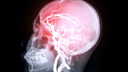 A scan of someone's skull, showing red and white lines across it