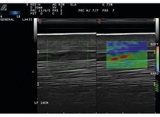 Elastography