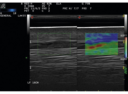 Elastography