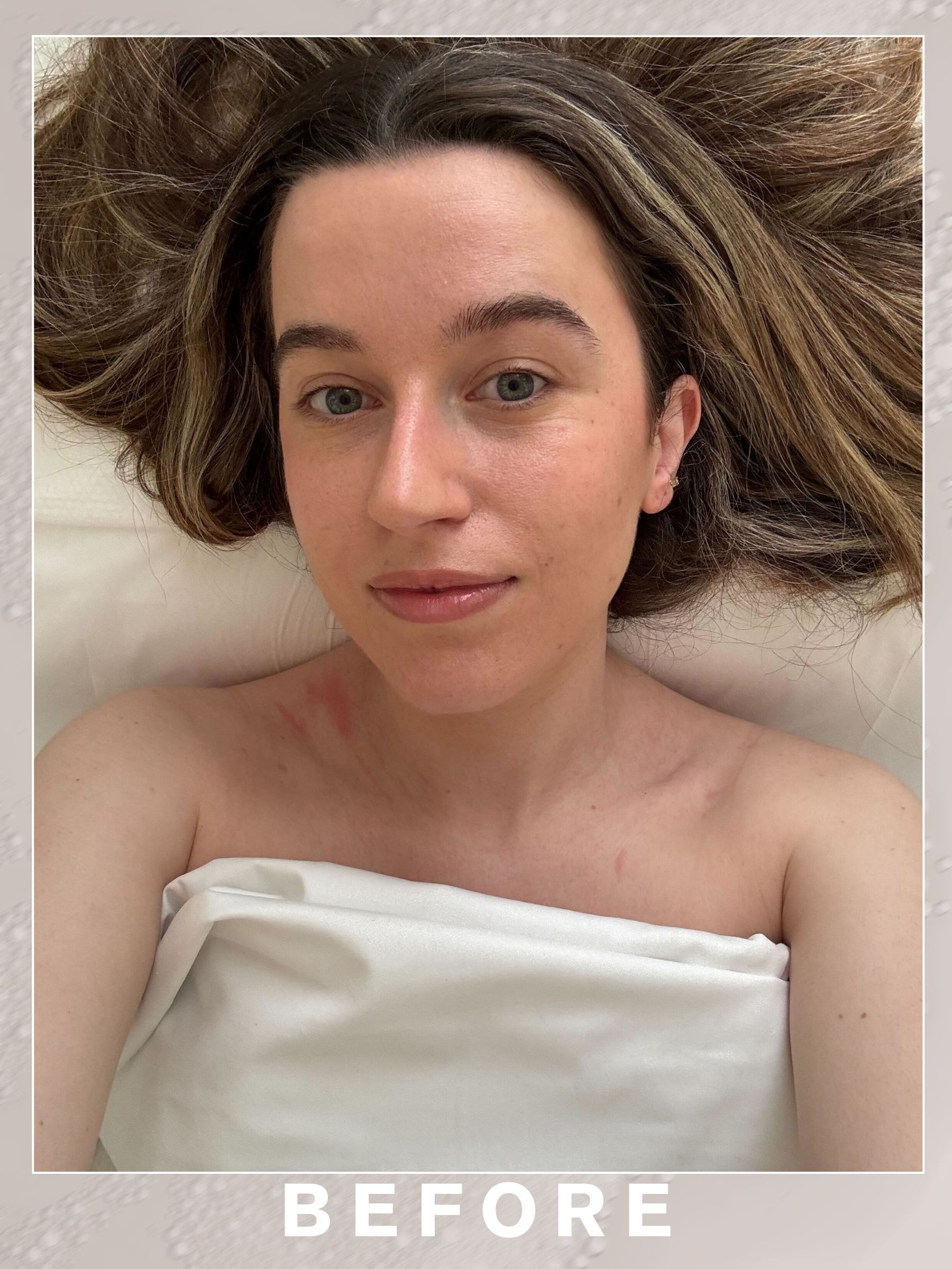 Deputy beauty editor Grace Lindsay before getting acupuncture