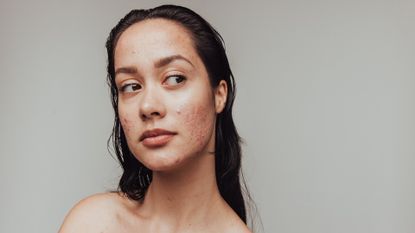 woman with acne from food