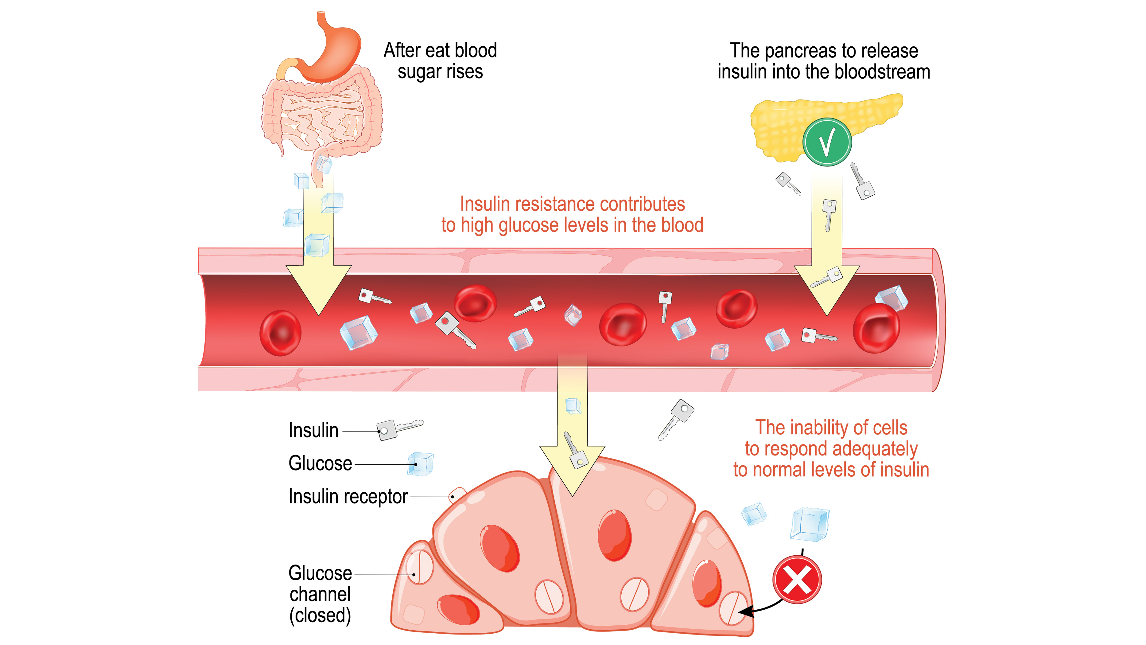 A diagram of how insulin resistance works.