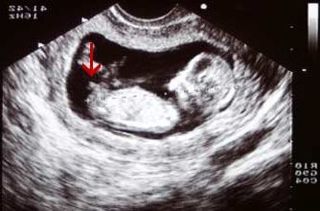 Image of a scan highlighting the nub of a boy