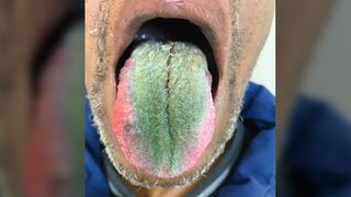A picture of a man's tongue coated in thick, green hair-like growths.