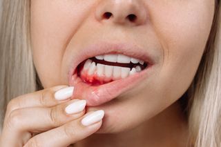 Woman with bleeding gums