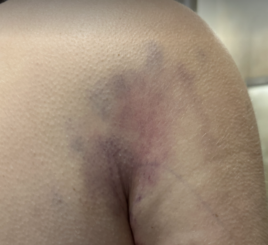Samantha Holender's bruising on the back of the arm on day 2. 