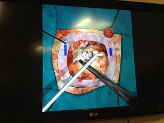 A simulated brain surgery is displayed on a video screen.