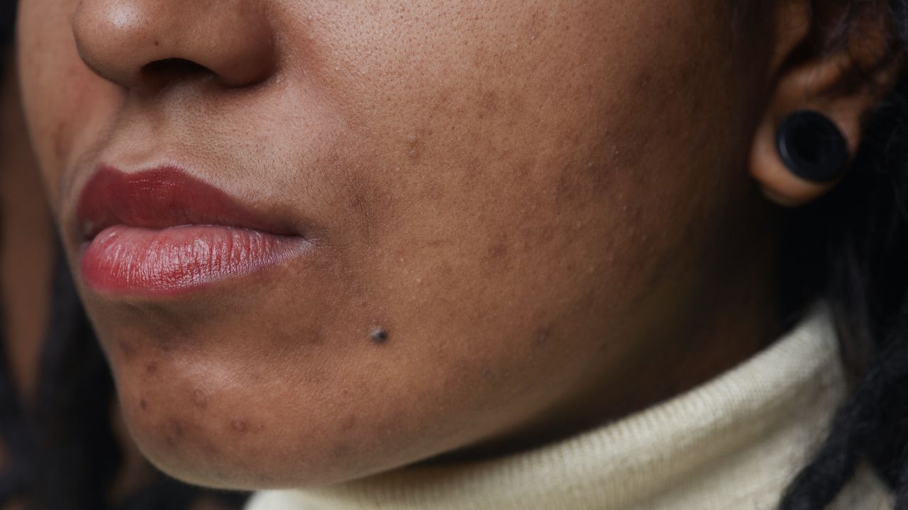 close up of woman with cheek and chin acne