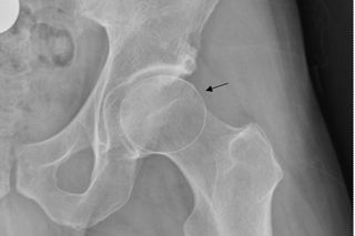 This image shows a hip looks like after arthroscopy surgery.