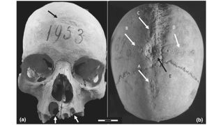 The woman's skull shows clear traces of a large cross-shaped incision in the top, with a partially-healed oval of bone at the center; and a patch on her forehead where the bone has been scraped thin. Researchers think both are evidence of trepanations, possibly in an attempt to cure extreme pain she was suffering from two large abscesses on her upper jaw.